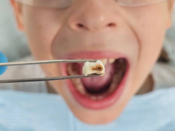 Best Chipped Tooth Repair Near Me  in Boone, IA